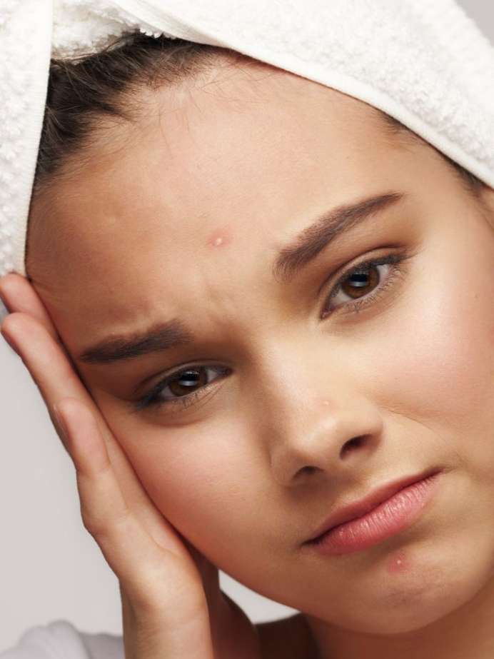 6 Skincare Mistakes That Can Cause Acne Breakouts How To Get Rid Of Acne