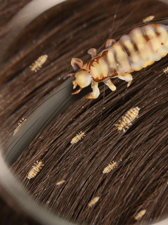 How To Get Rid Of Lice Really Fast