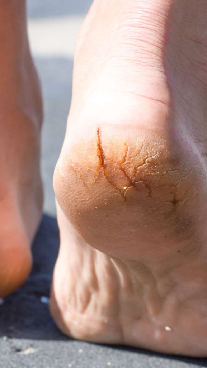 Relief From Cracked and Dry Skin | Austin Foot and Ankle Specialists