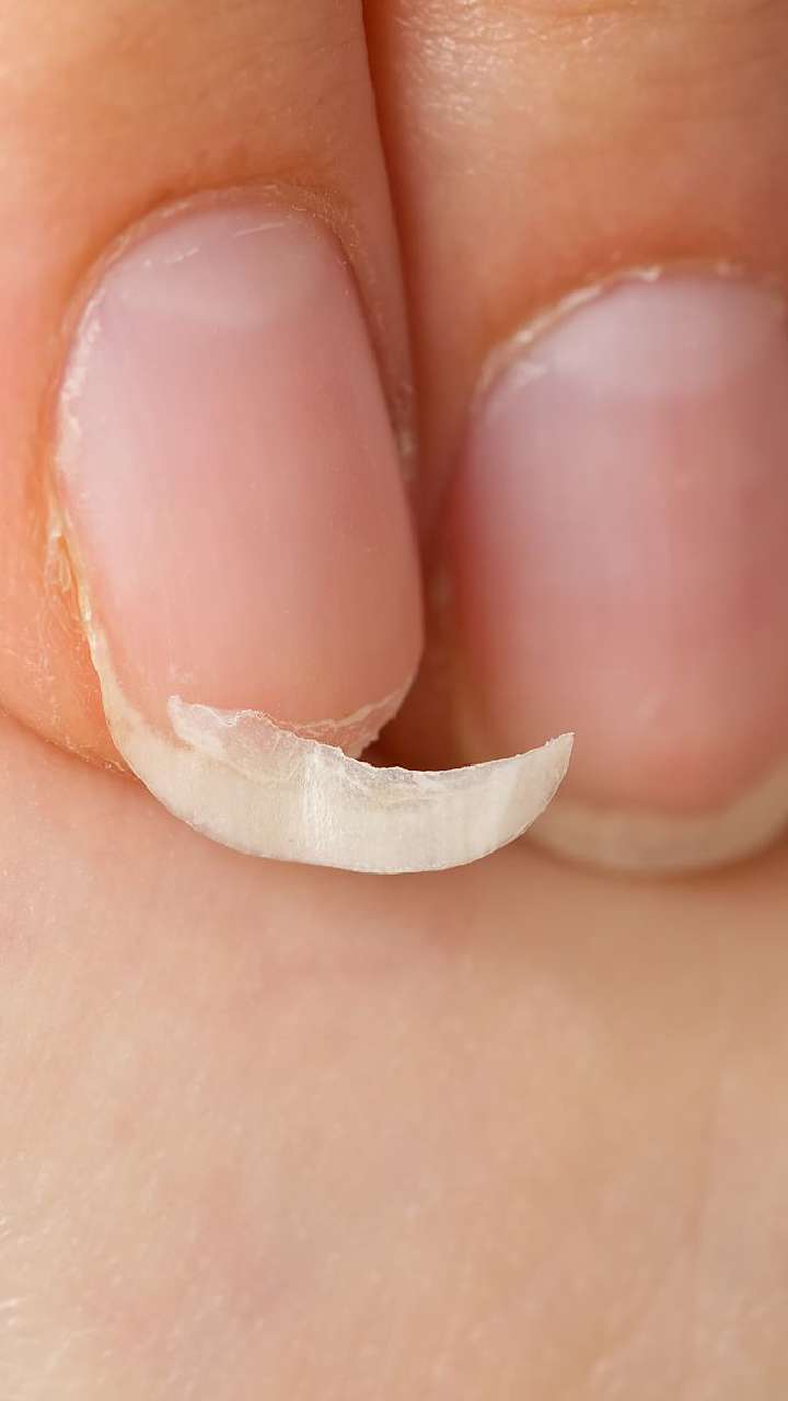 Reasons behind Toe Nail Fungal Infection & its Treatments | Flickr