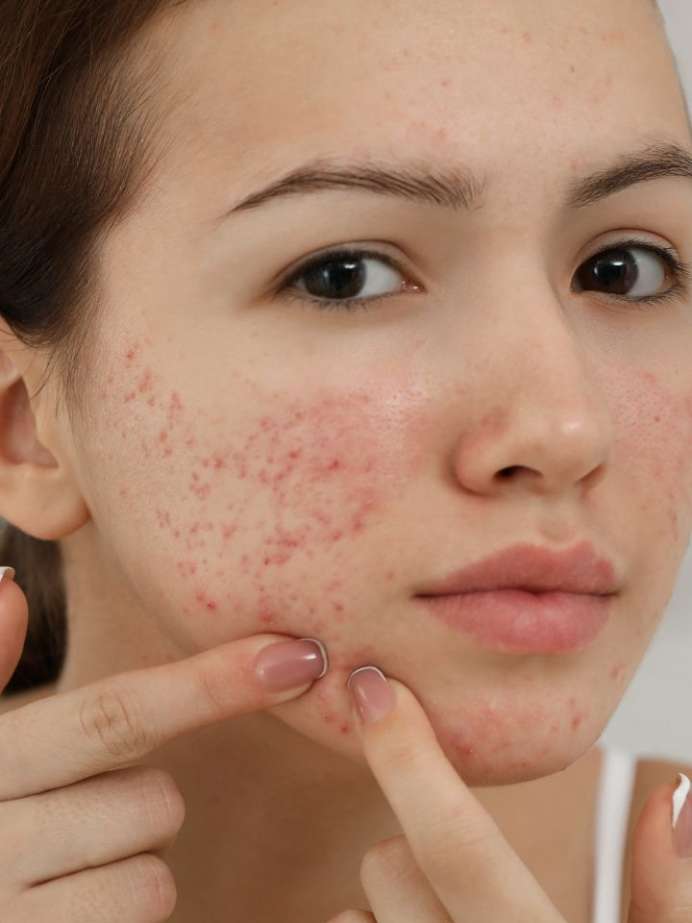 skintherapy-ask-the-esthetician-acne-surgery-and-popping-pimples