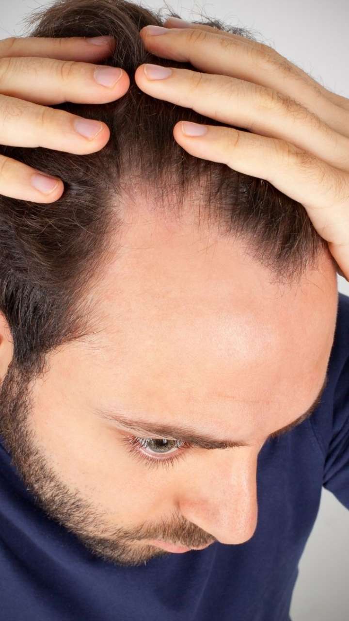 Receding Hairline Men: 10 Treatments That Can Help 2022