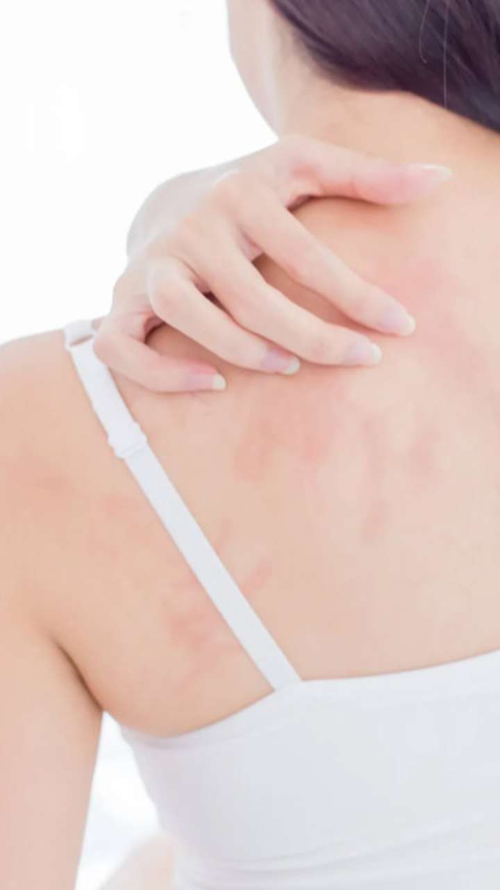 पीठ पर इस वजह से निकलते हैं लाल दाने, ऐसे करें बचाव