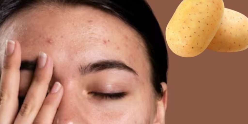 How To Use Raw Potato To Treat Scars On Face? Onlymyhealth