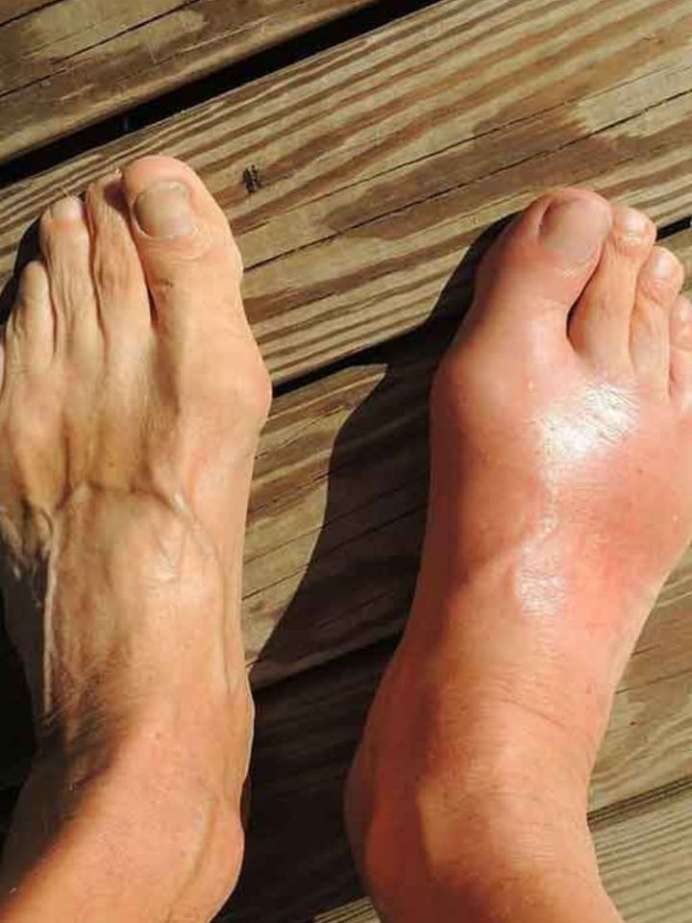 Top 6 Juices That Can Reduce Uric Acid Onlymyhealth