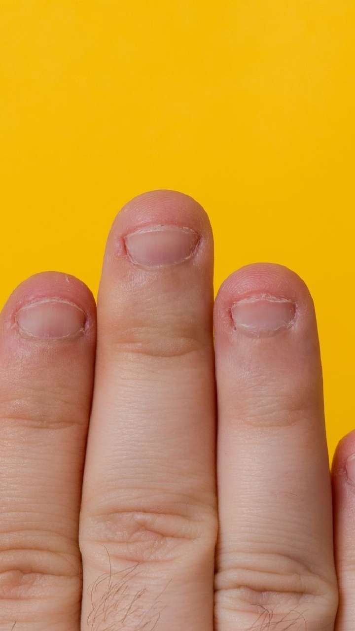 What Does Your Manicure Say About Your Health?: Yellow Nail Syndrome |  RxWiki