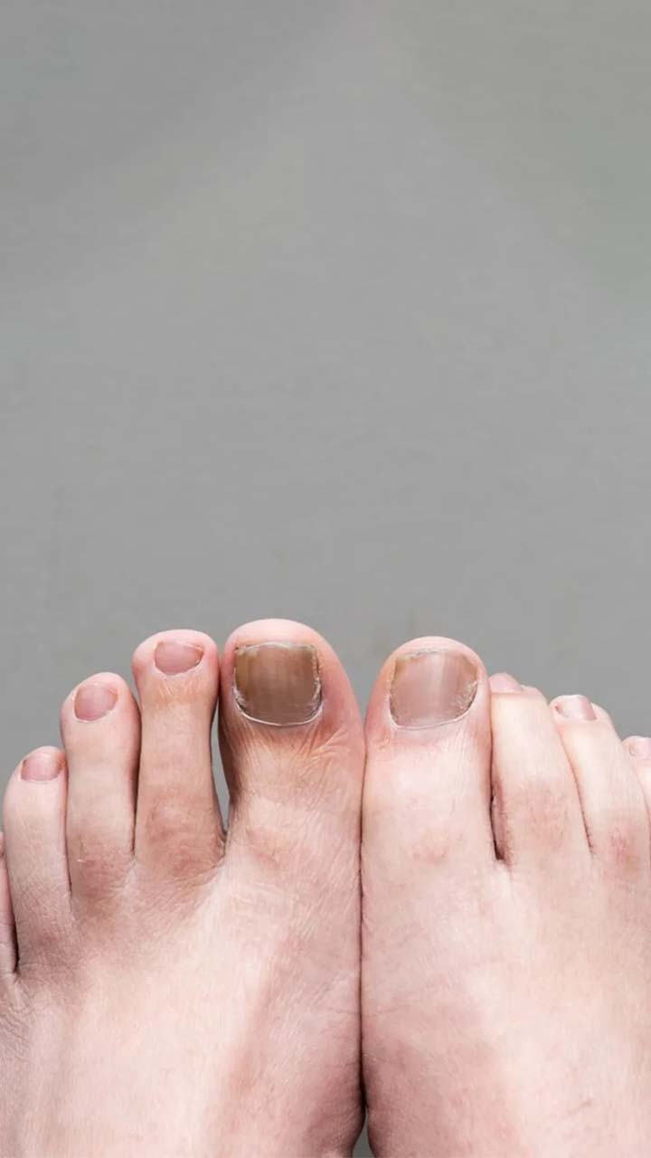 नाखूनों के फंगल इंफेक्शन को ऐसे करें दूर | Fungal Infection नाखूनों के फंगल इंफेक्शन को ऐसे करें दूर | Fungal Infection