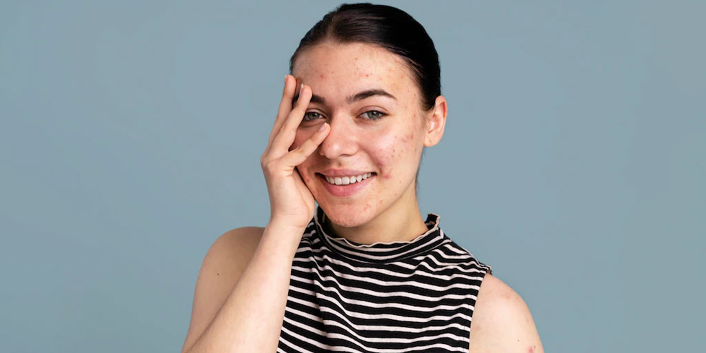 6 Ways To Avoid Acne And Pimples 6 Ways To Avoid Acne And Pimples
