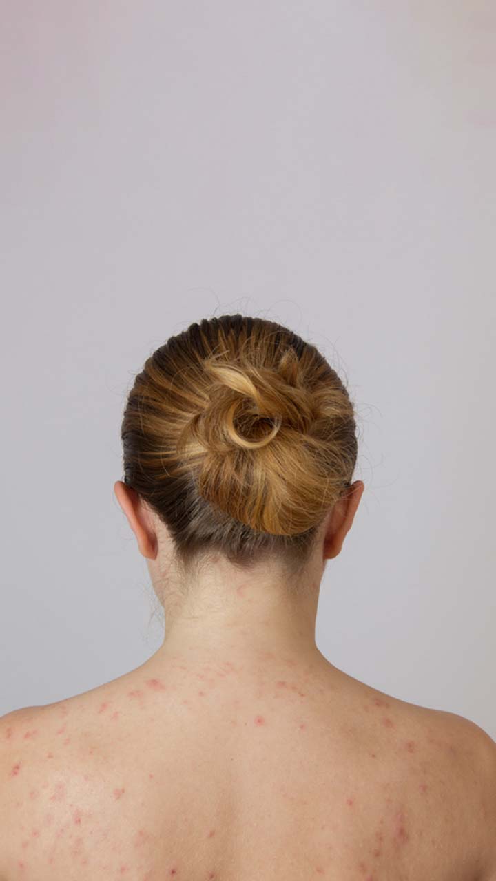 पीठ पर मुहांसे होने के कारण