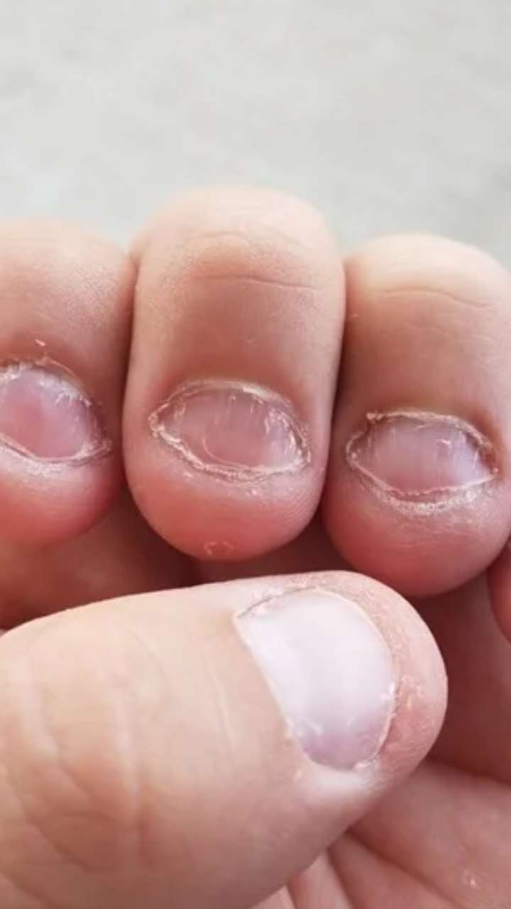 Why Do People Bite Their Nails When Stressed?