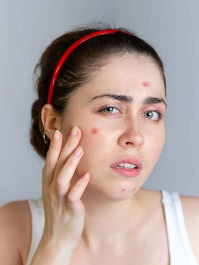 मुहांसे दूर करने वाले घरेलू फेस मास्क
