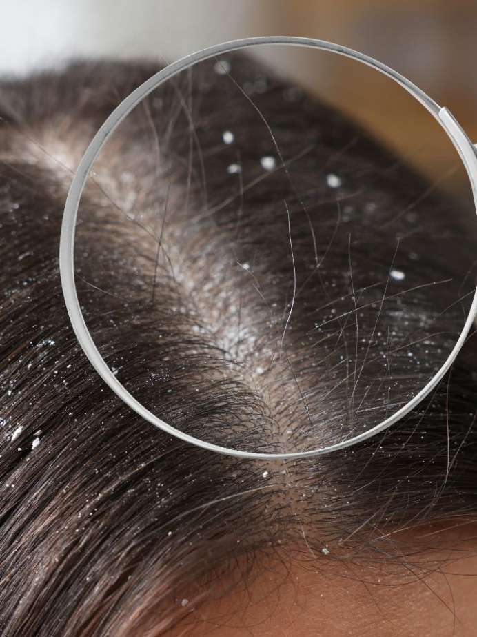 Why Scalp Infections Increase During Monsoon?