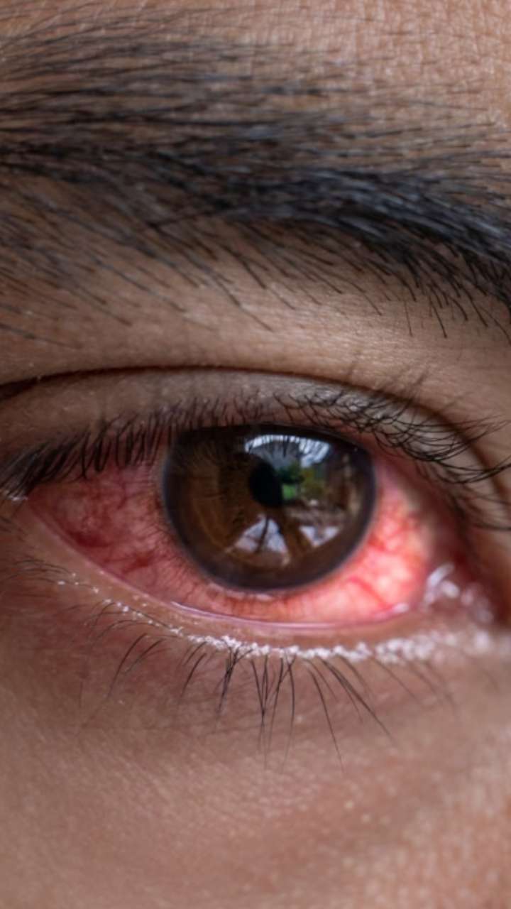 How to Treat Red Eyes in Monsoon?