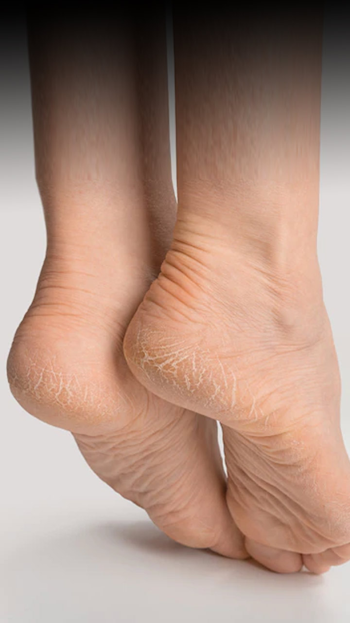 Fast Way to Fix Cracked Heels Permanently|फटी एड़ियों को कैसे ठीक करें|Fati  Adiyo ke Gharelu Upay | homemade remedies for cracked heels | HerZindagi