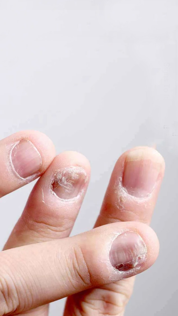 Acral Peeling Skin Syndrome: Signs, Causes, Treatment, More
