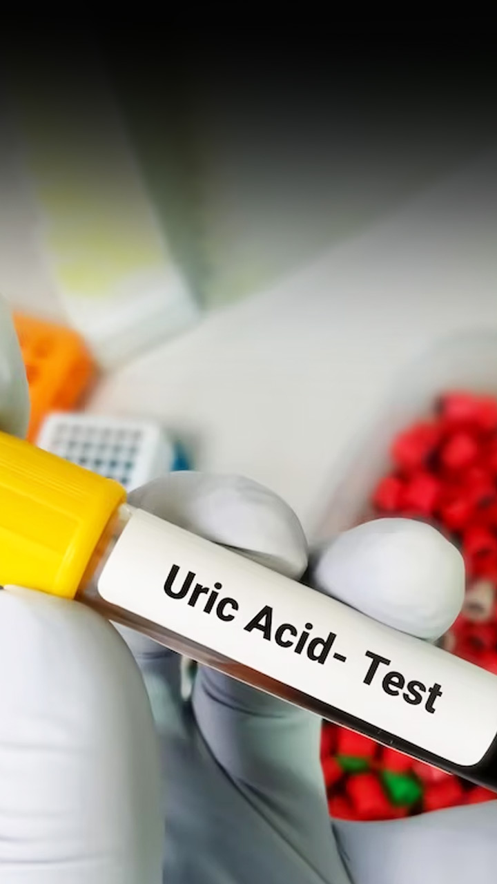 Healthy Tips To Control Uric Acid Level