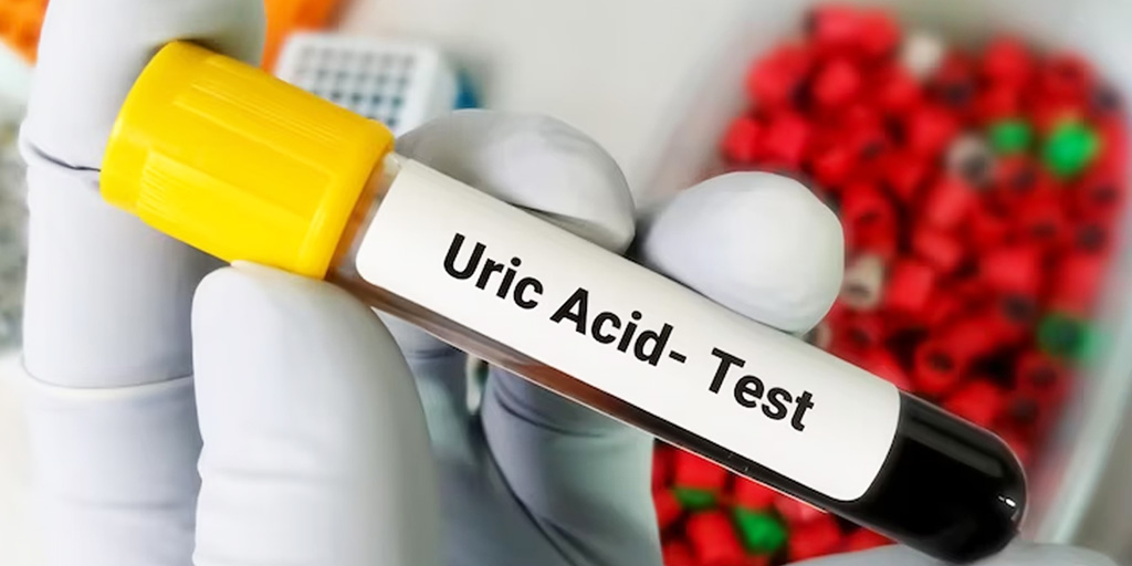 Tips To Control Uric Acid Level