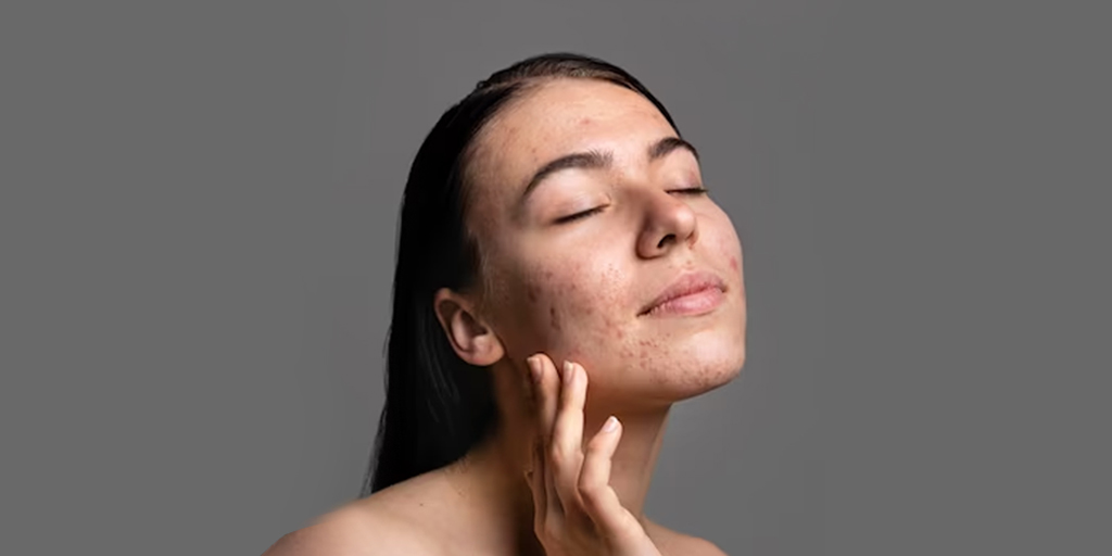 home-remedies-to-reduce-hormonal-acne