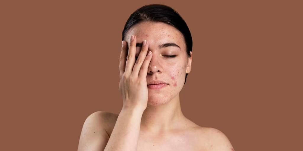 Causes of hormonal acne