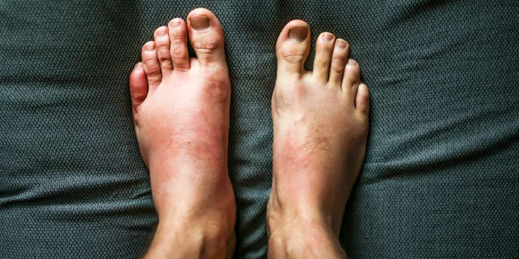 causes of swollen feet and ankles