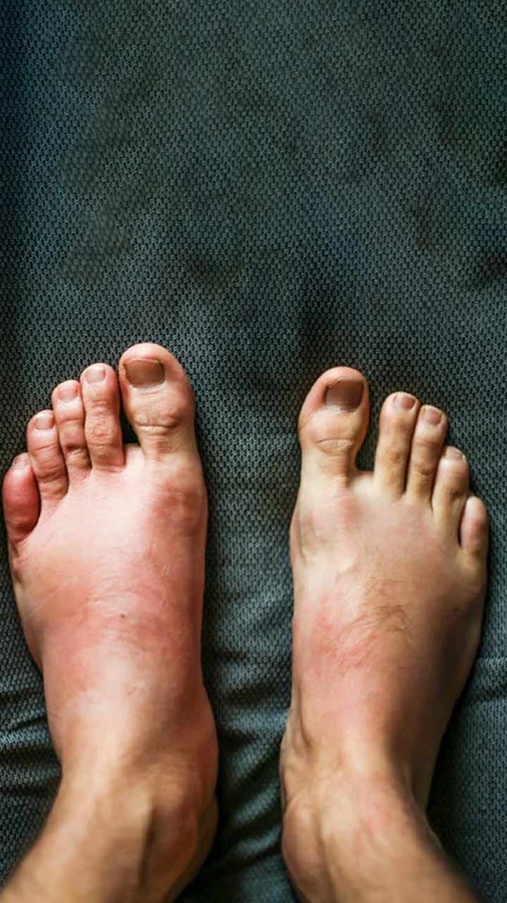 Are Your Feet And Ankles Swollen Here Re The Causes