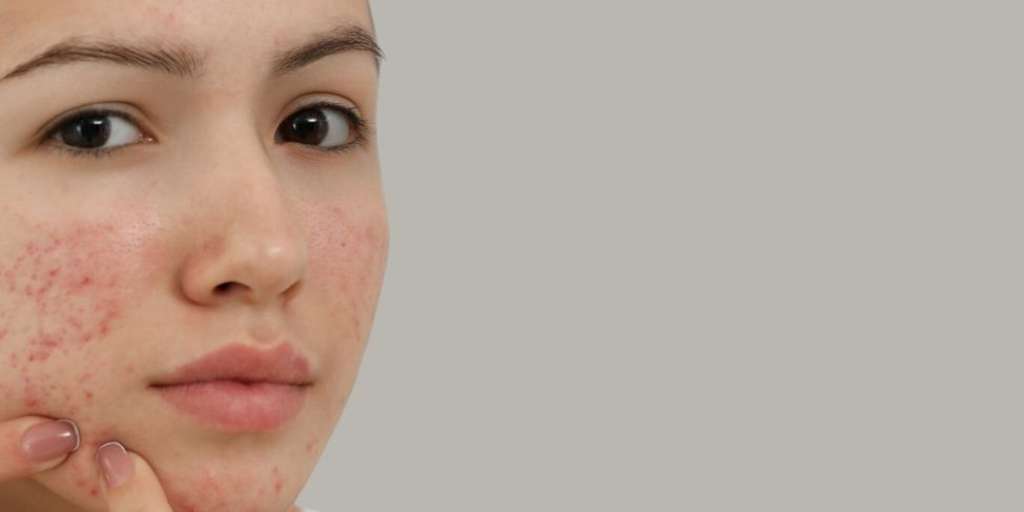 small-bumps-on-your-face-that-resemble-acne-onlymyhealth