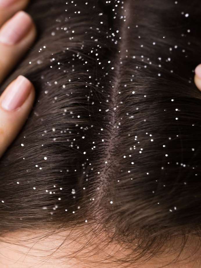 Dont Fall For These Popular Dandruff Myths Onlymyhealth 9112